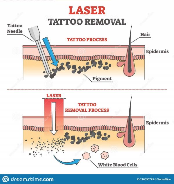 Long Fine Needles For Laser Plasma Pen Skin Dark Spot Remover Mole Tattoo  Removal Machine | Wish